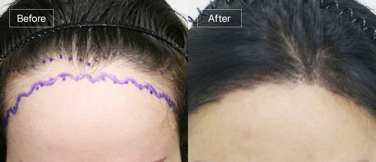 /filedata/md_board/20251229130050_yM7fdDqO_sub3_slide1.jpg 전후사진