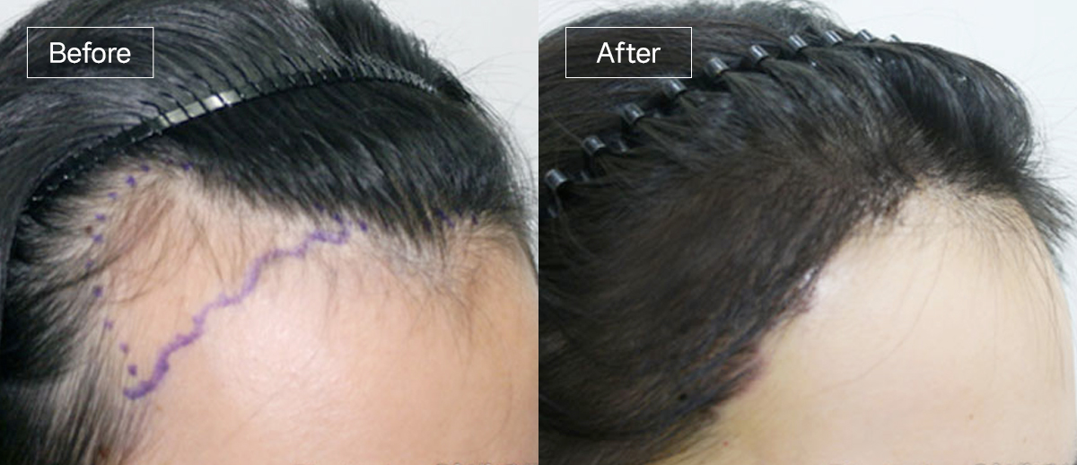 /filedata/md_board/20251229130105_ZYUEGzCg_sub3_slide3.jpg 전후사진