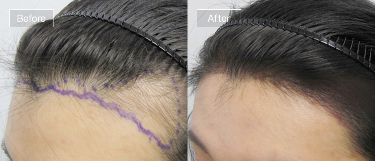 /filedata/md_board/20251229130111_r4z9GPV8_sub3_slide4.jpg 전후사진