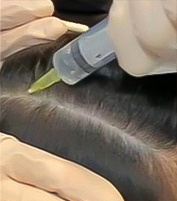 scalp