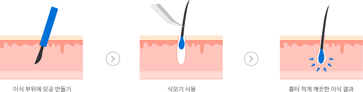 모낭1