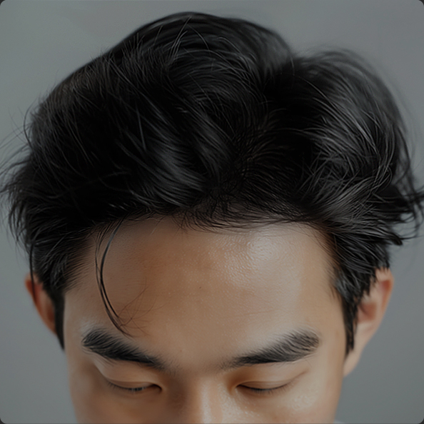 연세모벨르의원 모발이식