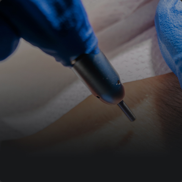 연세모벨르의원 SMP 두피문신