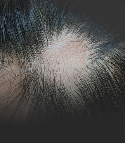 연세모벨르의원 기타부위이식